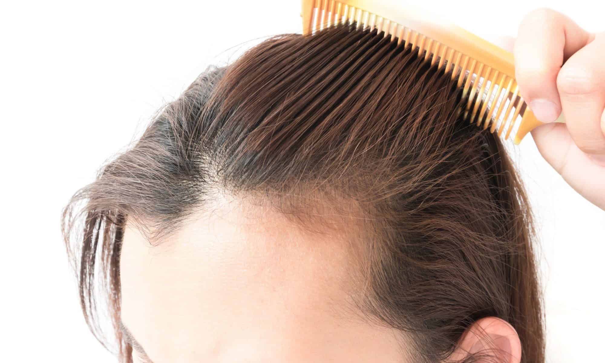 علاج صلع الشعر على الطريقة الماليزية